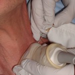 Ultrasound guided fine needle aspiration